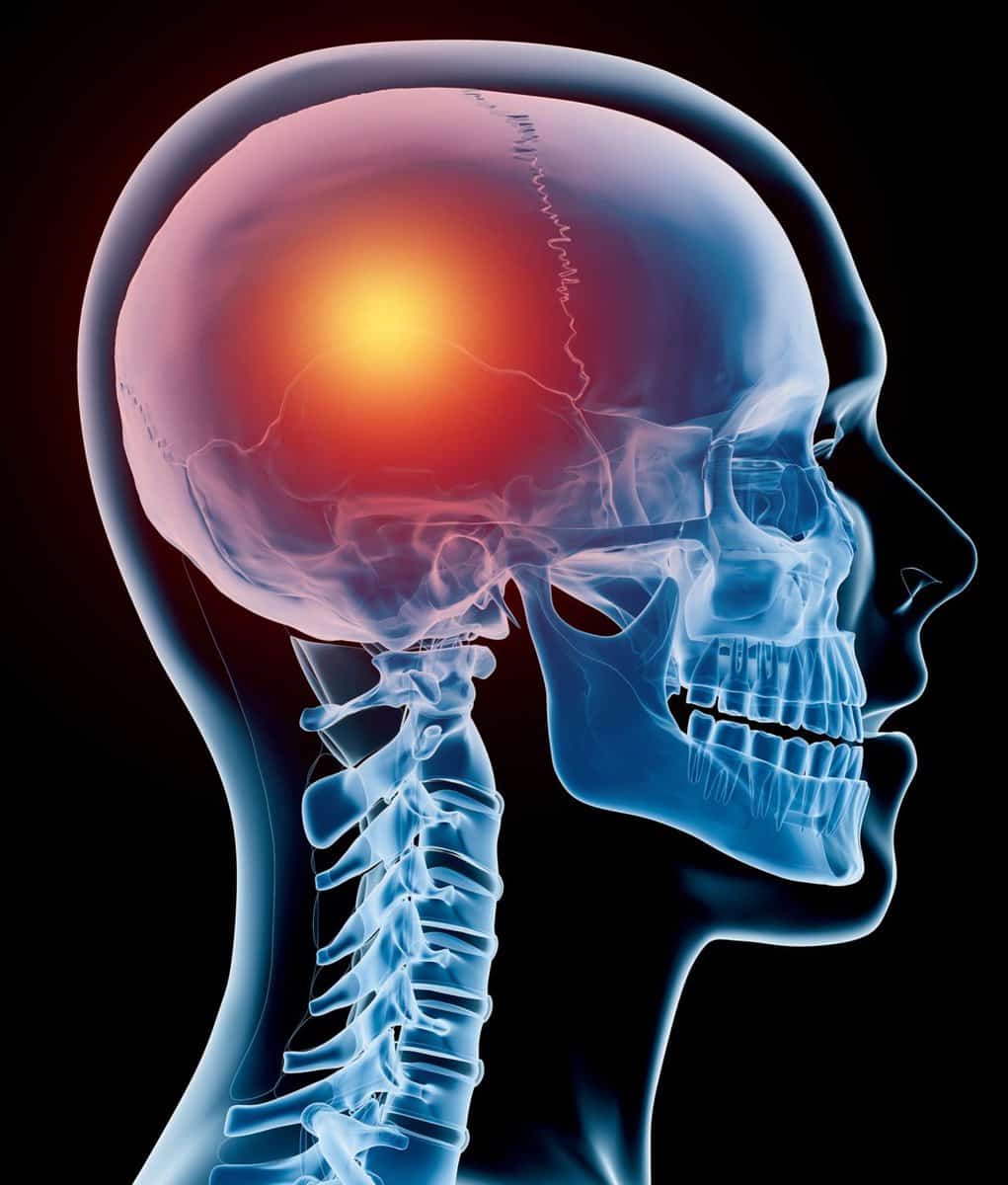 Head Pain
