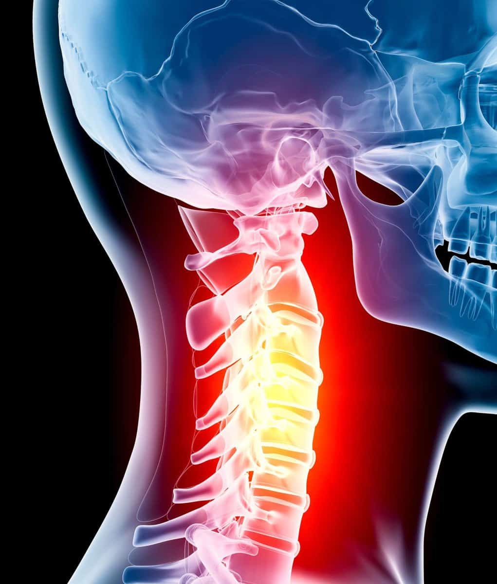 Neck Pain